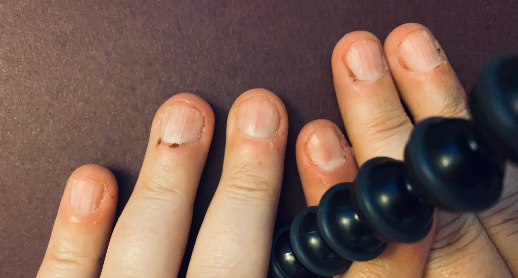 A close-up of six fingers against a dark background. The fingernails and cuticles are all bitten and scabbed to different degrees.